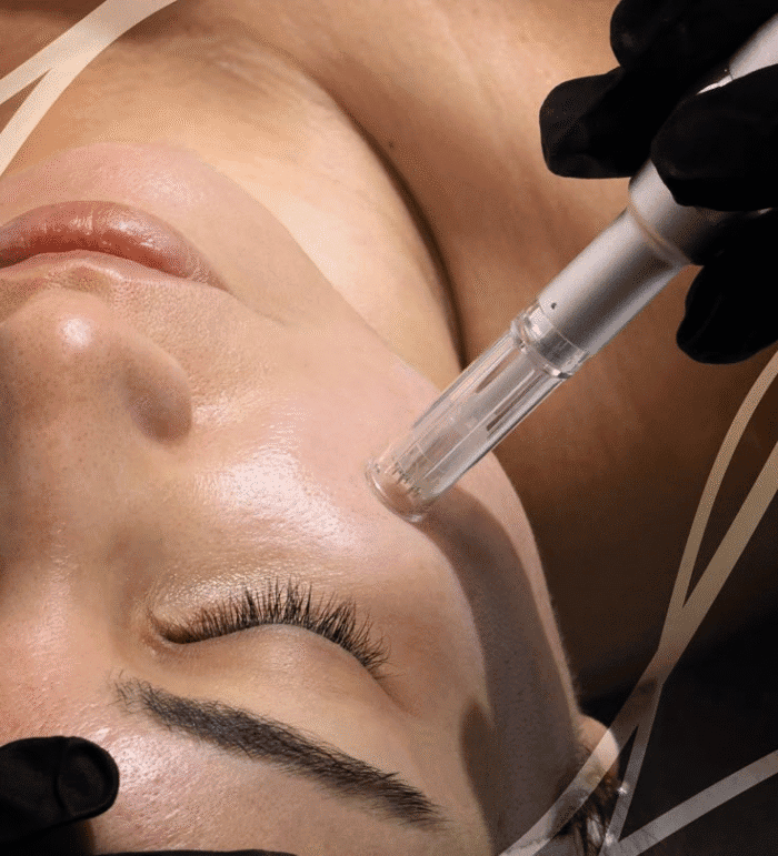 Skin Needling