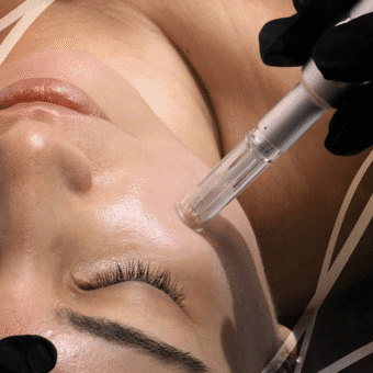 Skin Needling - Face
