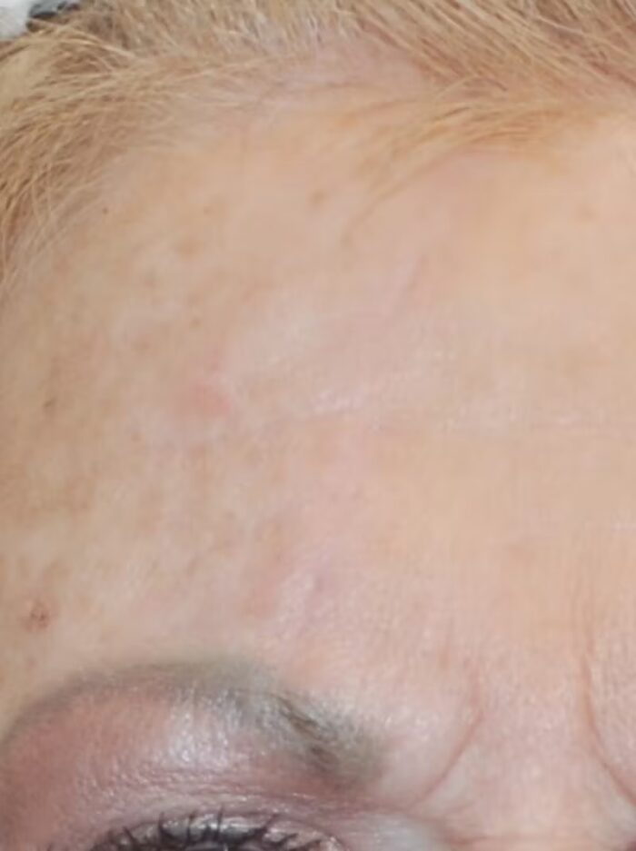 Exosome After Image. Woman with no scarring
