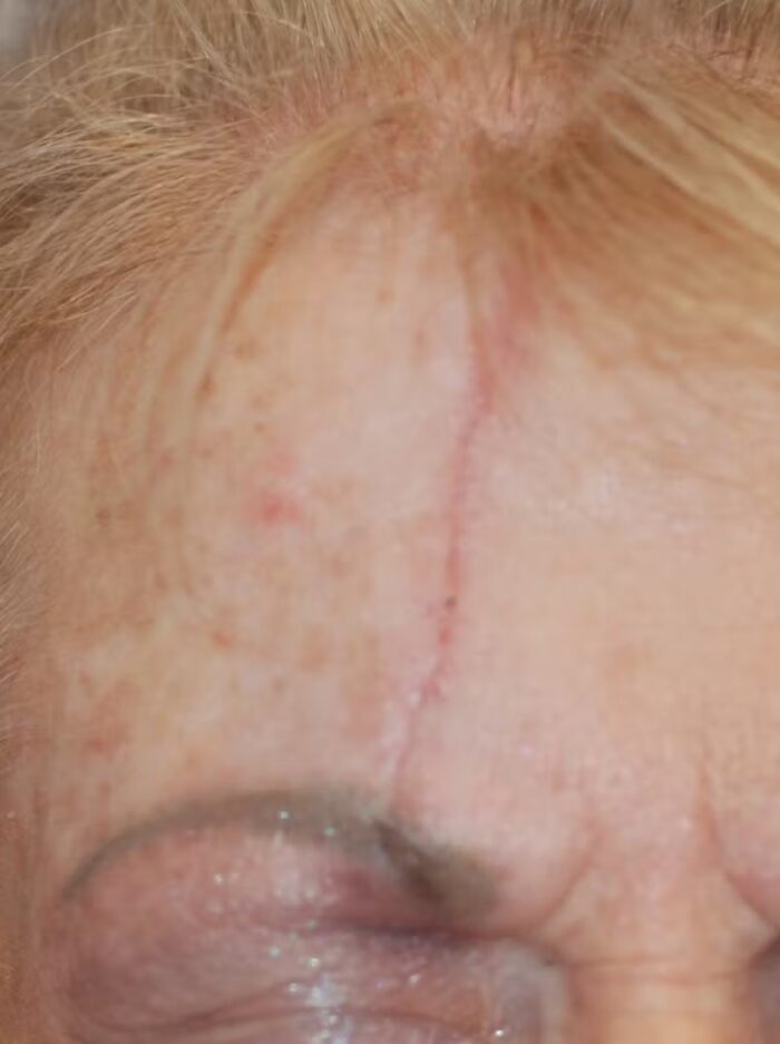 Exosome Before Image. Woman with scarring