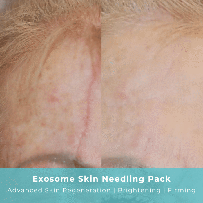 Exosome Skin Needling Pack